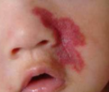 婴儿疤痕为什么不建议在婴儿还小的时候做手术呢？
