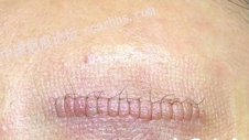 为什么疤痕体质的人不适合整形？青岛皮肤病医院介绍疤痕体质