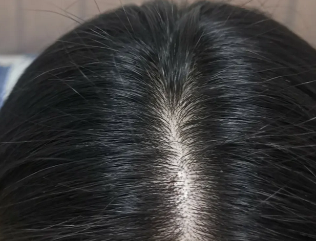 女性脱发的原因有哪些呢？青岛皮肤病医院详细介绍5个方面