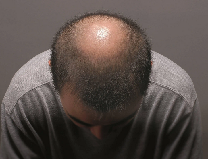 男性脱发的明显症状-青岛金肤康医院机构十大排行-青岛皮肤病医院
